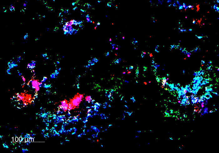 breast cancer metastases